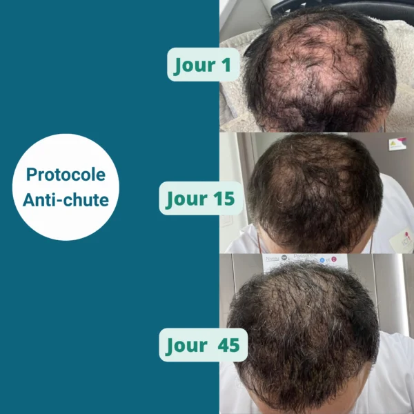 Protocole Anti-chute de cheveux - Caditar resultats de la cure