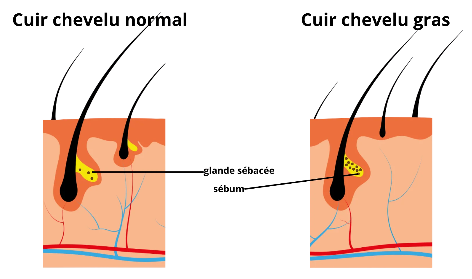 cheveux gras sebum